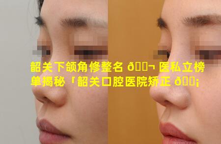 韶关下颌角修整名 🐬 医私立榜单揭秘「韶关口腔医院矫正 🐡 牙齿价格」